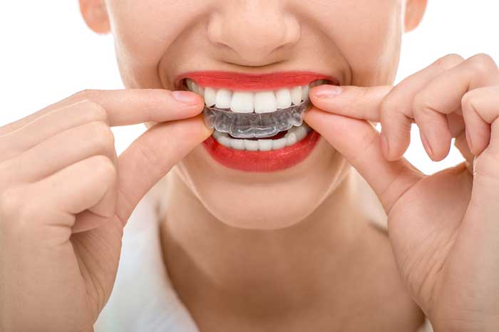 A girl wearing Invisible braces in the teeth