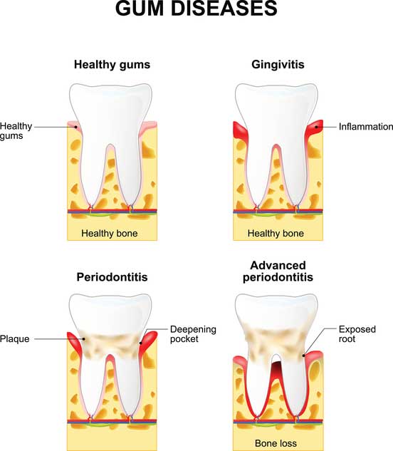 Different types of gum diseases