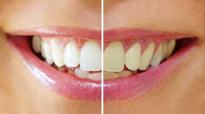 Cosmetic Dentistry of teeth