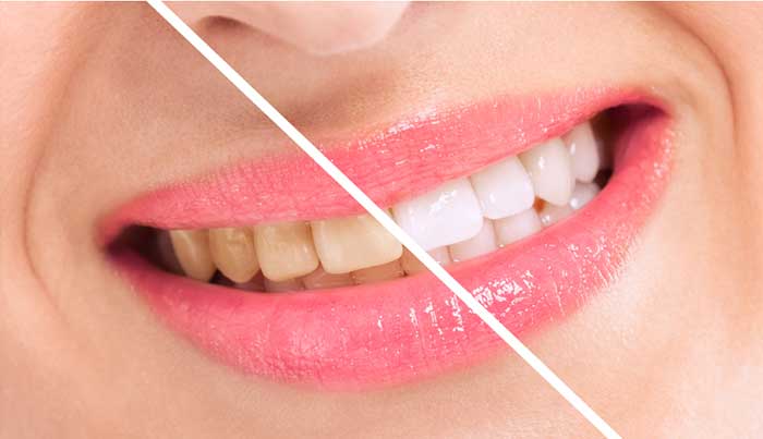 Darker side of teeth
