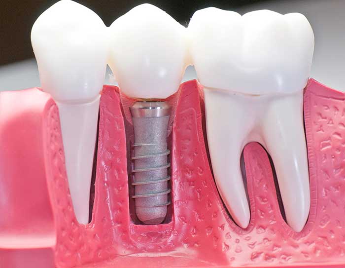Dental Implant