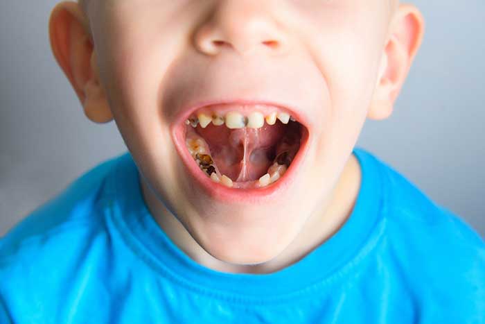 A small boy with decayed teeth