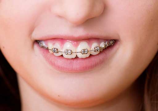 A girl wearing braces
