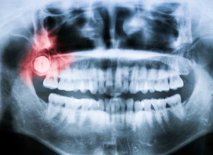Xray of wisdom teeth