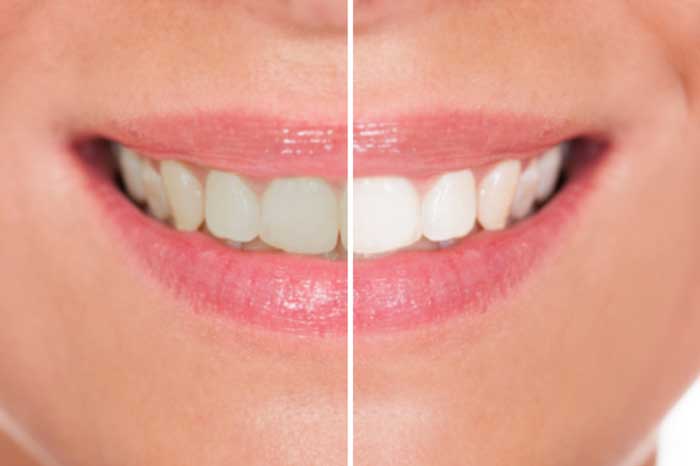 Darker side of teeth
