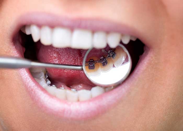 A girl wearing braces