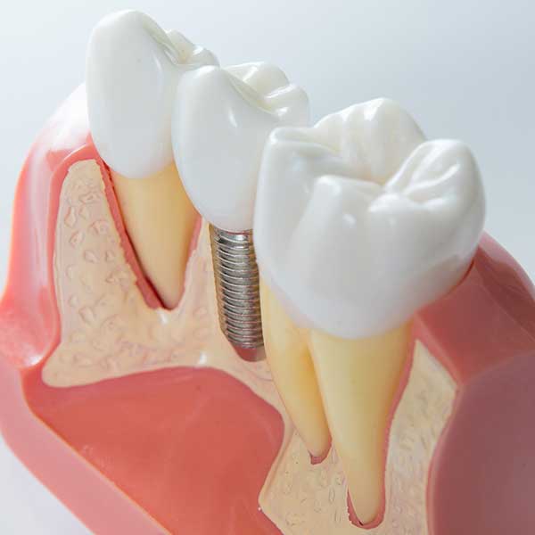 Dental implants